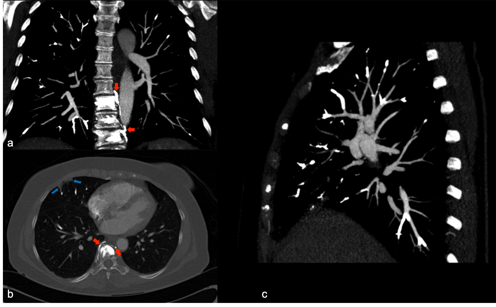 Pulmonary Cement Embolism After Kyphoplasty Clinical And Isth